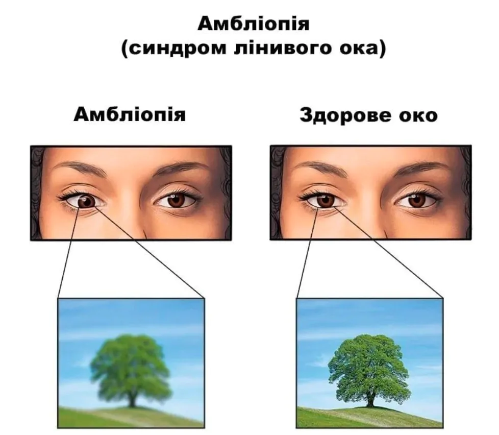 амбліопія інвалідність